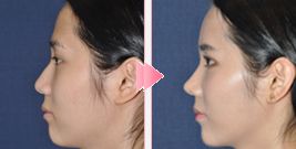 韩国4月31日整形外科鹰钩鼻矫正对比照片