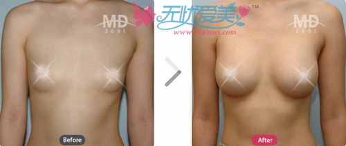 韩国MD整形医院隆胸对比案例1