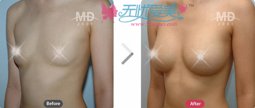 韩国MD整形医院隆胸对比案例2