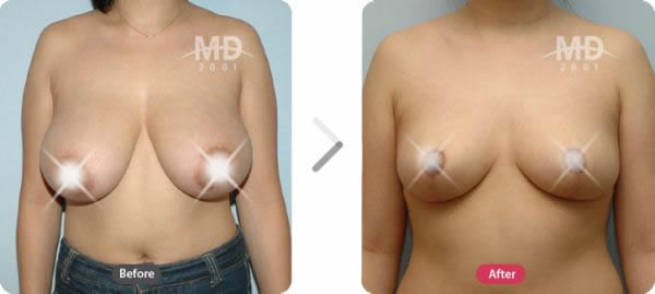 韩国MD整形外科巨乳缩小+乳晕改小对比案例 