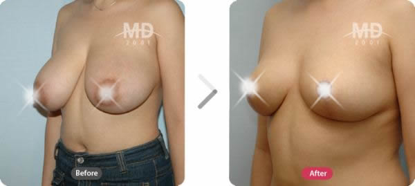 韩国MD整形外科巨乳缩小术+乳晕缩小术对比案例