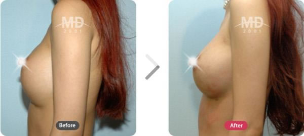乳房上提整形手术前后对比照片