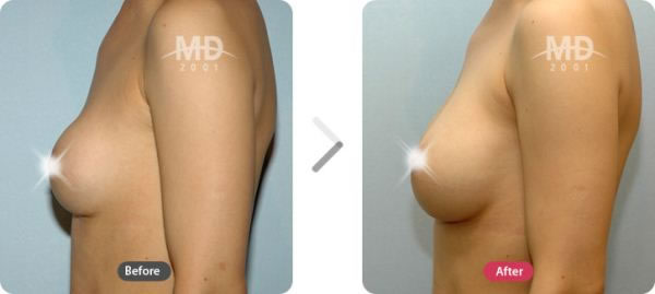 假体隆胸整形手术前后对比照片