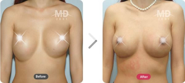 乳房上提整形术前后对比照片