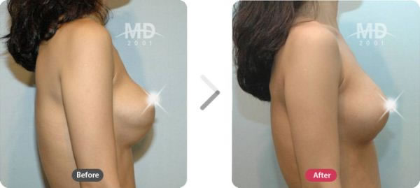 乳房畸形矫正术前后对比照片