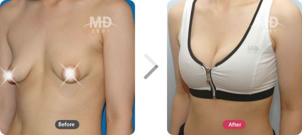 乳房下垂矫正及隆胸整形术前后对比照片