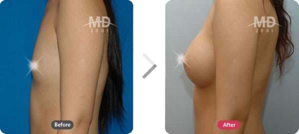韩国MD整形外科假体隆胸手术对比案例 
