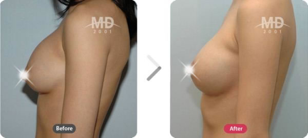 韩国MD整形外科假体隆胸对比案例