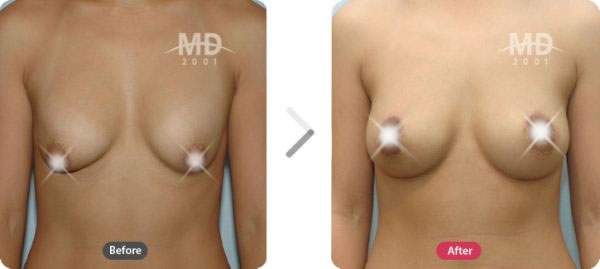 韩国MD整形外科假体隆胸+乳房下垂矫正术对比案例