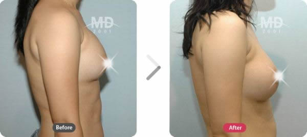 假体隆胸整形术前后对比照片