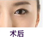 北京清木整形眼部手术