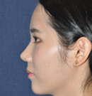韩国4月31日整形外科鹰钩鼻矫正对比照片