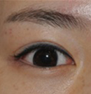 韩国4月31日整形外科眼部手术前后对比图