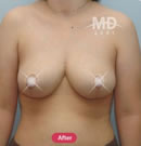 韩国MD整形外科巨乳缩小术+乳房下垂矫正术对比案例