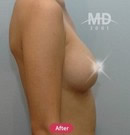 韩国MD整形医院隆胸对比案例3