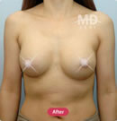 乳房不对称矫正术前后对比照片