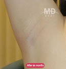 韩国MD整形外科胸部整形手术腋下疤痕对比案例