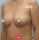 韩国MD整形外科假体隆胸手术+乳房下垂矫正手术对比案例