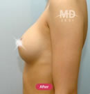 乳房不对称矫正整形手术前后对比案例