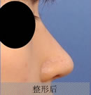 驼峰鼻矫正整形手术