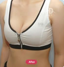 乳房下垂矫正及隆胸整形术前后对比照片