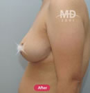 韩国MD整形外科巨乳缩小+乳房下垂矫正对比案例