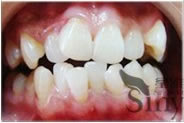 牙齿3D美容冠前后对比照