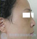 北京清木整形鼻综合手术