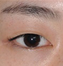 韩国4月31日整形外科眼部手术前后对比图