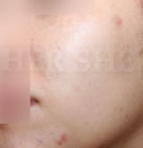 注射PRP改善皮肤斑痕案例对比