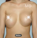 乳房上提整形术前后对比照片
