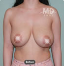 韩国MD整形外科乳房下垂矫正+乳晕缩小+巨乳缩小对比案例