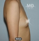 韩国MD整形医院隆胸对比案例3