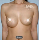 乳房左右不对称矫正术前后对比照片