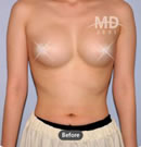 假体隆胸手术前后对比照片
