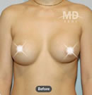 胸部整形手术前后对比照片