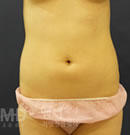 腹部吸脂整形手术前后对比照片