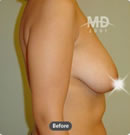 韩国MD整形外科乳房下垂悬吊术对比案例