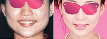 北京改脸型 下颌角整形手术日记  