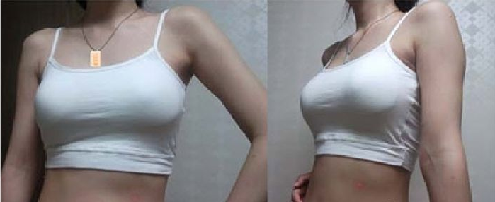 假体丰胸术后2周