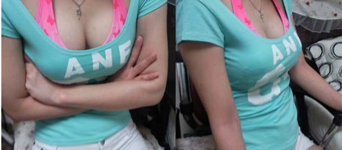 假体丰胸术后2个月