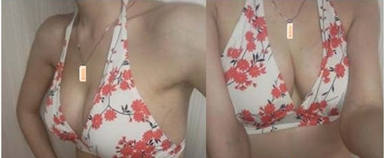 假体丰胸术后1个月