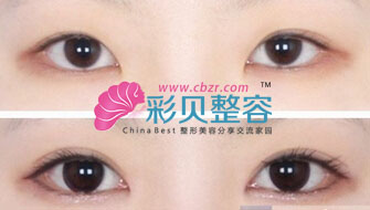 开眼角前后对比图