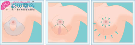 乳房提升效果