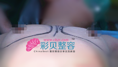 自体脂肪隆胸术前