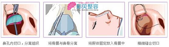 假体隆鼻的手术方法