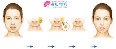 瘦脸过程