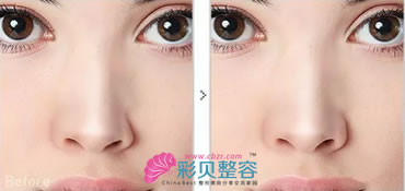鼻翼不对称矫正对比图