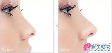 鼻尖低矫正对比图