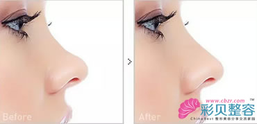 鼻梁低矫正对比图